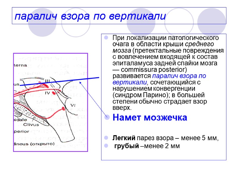 паралич взора по вертикали При локализации патологического очага в области крыши среднего мозга (претектальные